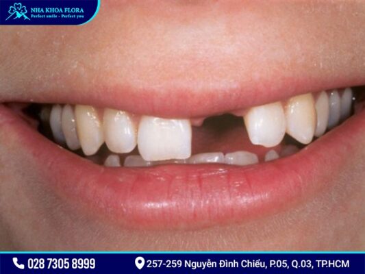 Trồng răng cửa - ảnh 1