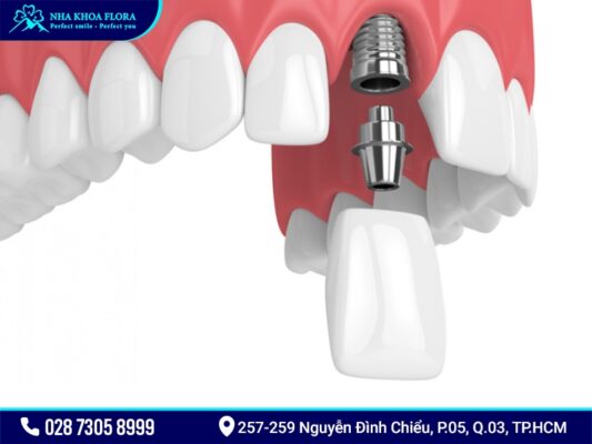 Trồng răng cửa - ảnh 2