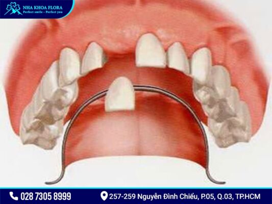 Trồng răng cửa - ảnh 3