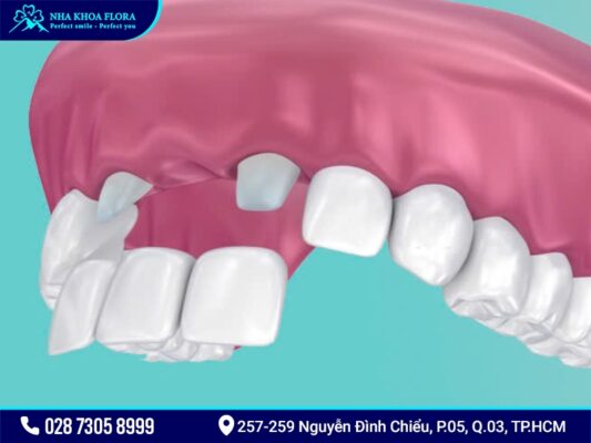 Trồng răng cửa - ảnh 4