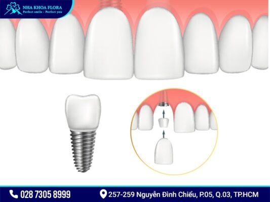 Trồng răng cửa - ảnh 5
