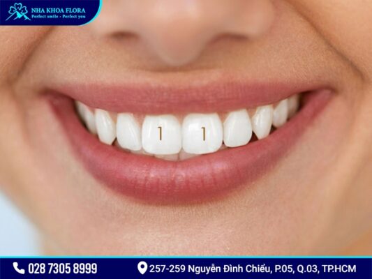 Trồng răng cửa - ảnh 6