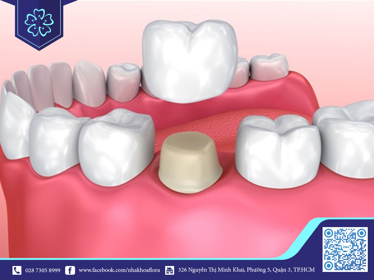 nhổ răng sâu hàm dưới