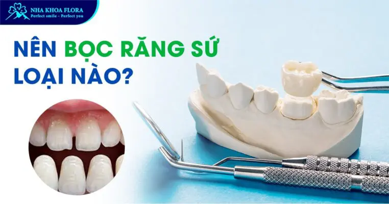 Nên Bọc Răng Sứ Loại Nào Tốt? Tư Vấn Cách Chọn 3