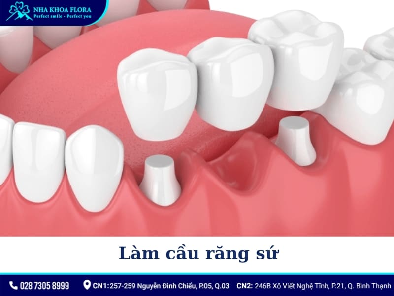 quy trình bọc răng sứ