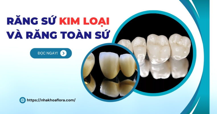 Răng sứ kim loại và răng toàn sứ