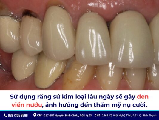 Tác hại của răng sứ kim loại - ảnh 5