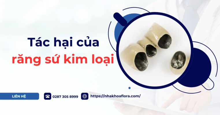 Tác hại của răng sứ kim loại