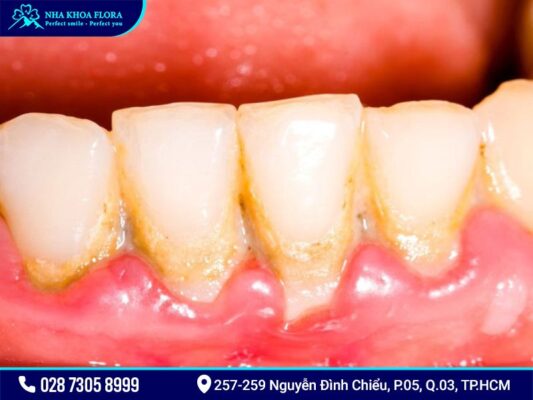 Tác hại của vôi răng - ảnh 1