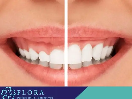 CÓ NÊN ĐIỀU TRỊ CƯỜI HỞ LỢI HAY KHÔNG? 2