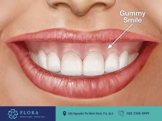 Chữa cười hở lợi bao nhiêu tiền là phù hợp 3