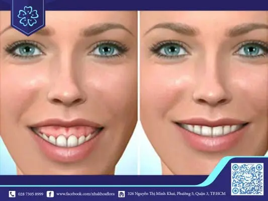 Những phương pháp chữa cười hở lợi ở Việt Nam 2