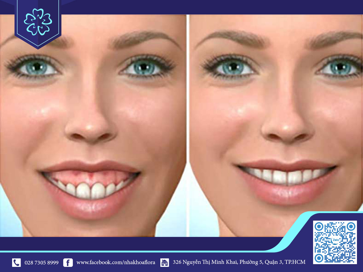 Những phương pháp chữa cười hở lợi ở Việt Nam 2