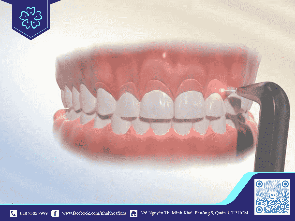 phương pháp chữa cười hở lợi