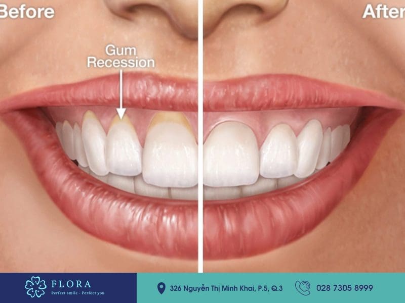 Những phương pháp chữa cười hở lợi ở Việt Nam 1