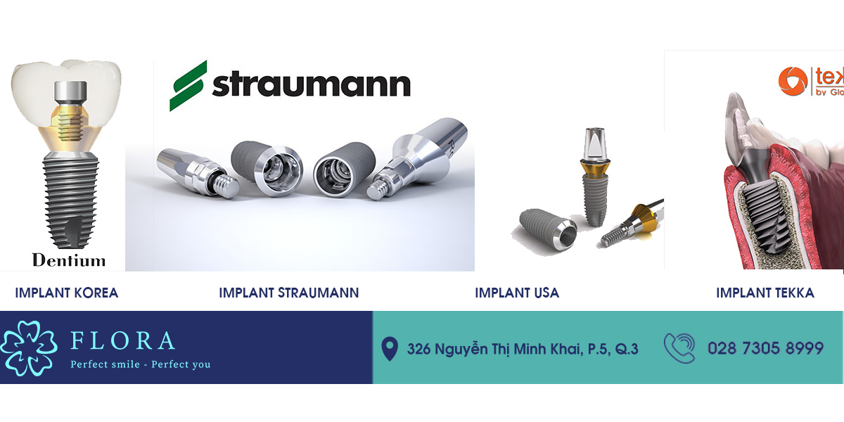 cac-loai-implant-hien-nay