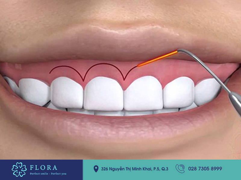 dich-vu-cuoi-ho-loi-flora