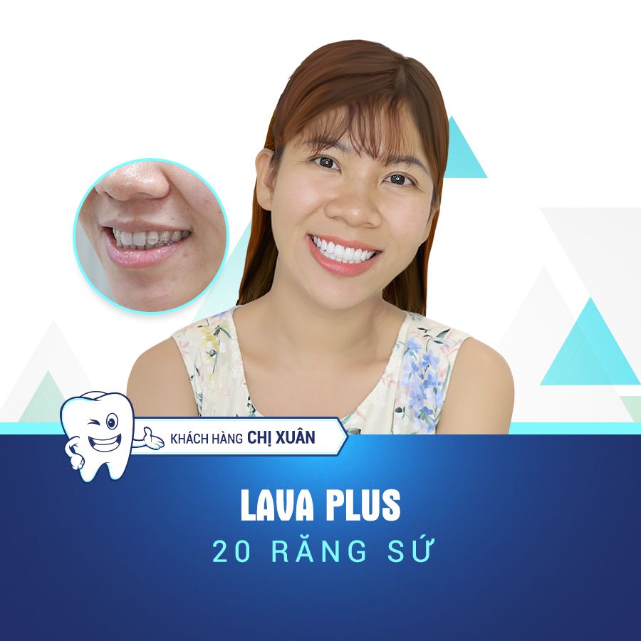 biến chứng bọc răng sứ