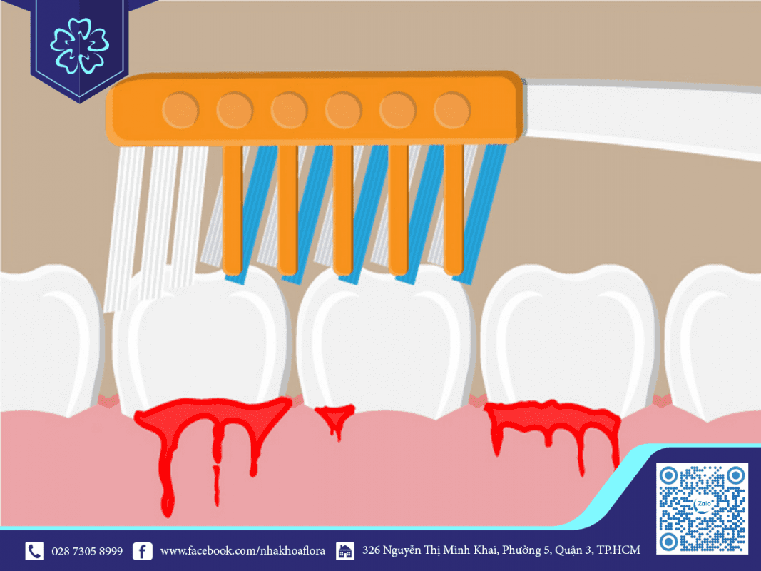 chảy máu chân răng chảy máu chân răng