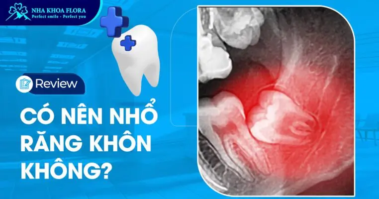 Review Có Nên Nhổ Răng Khôn Không Từ Bác sĩ? 3