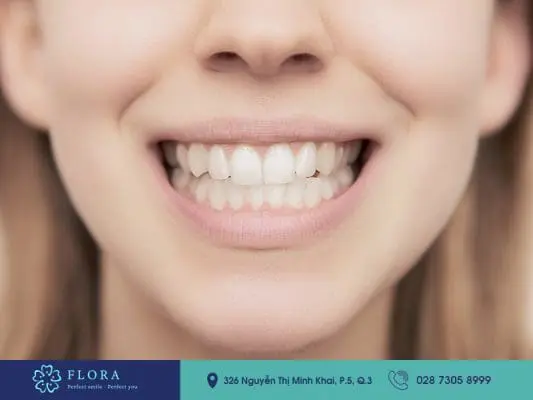 Cười hở lợi có chữa được không? 4