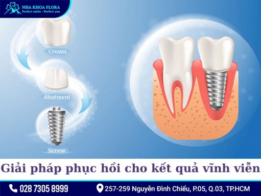 Lợi ích của trồng răng Implant - ảnh 2
