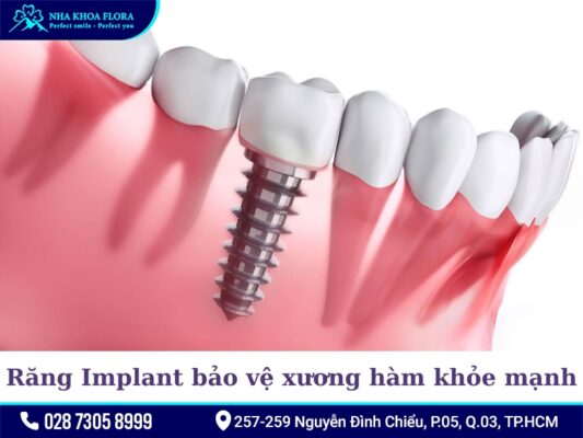 Lợi ích của trồng răng Implant - ảnh 4