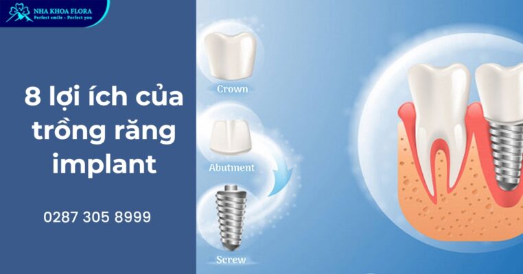 Lợi ích của trồng răng Implant