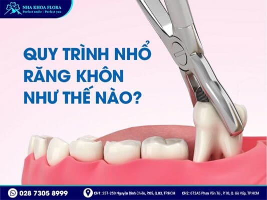quy trình nhổ răng khôn - ảnh 1