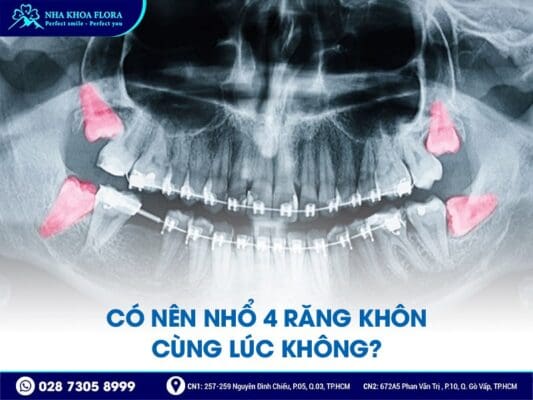 quy trình nhổ răng khôn - ảnh 3