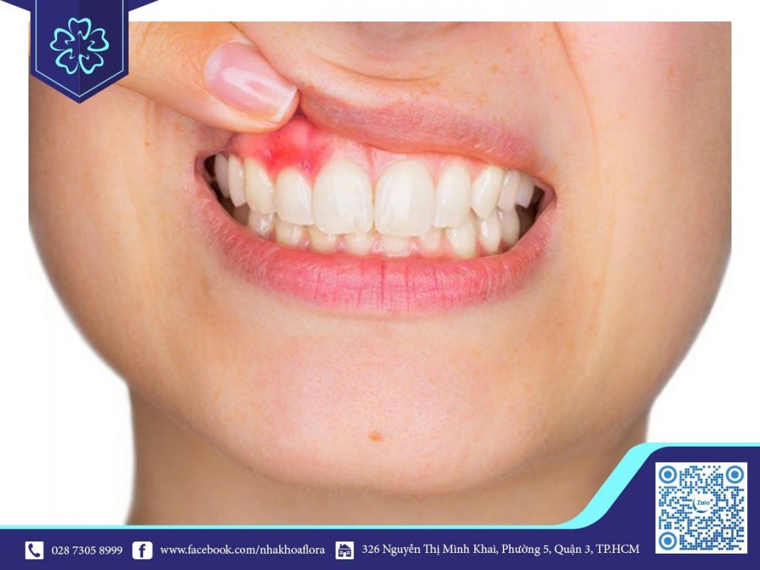 Viêm lợi chảy máu chân răng có nguy hiểm không?