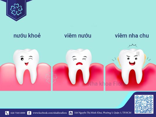 viem-nuou-va-viem-nha-chu viêm nướu và viêm nha chu