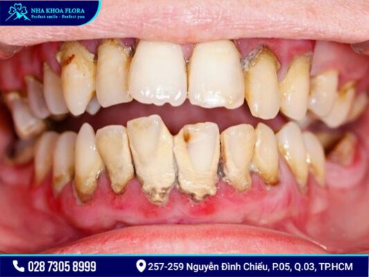 bệnh răng miệng - ảnh 4