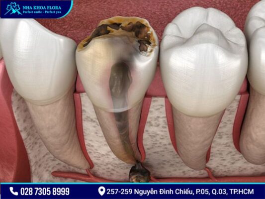 bệnh răng miệng - ảnh 5