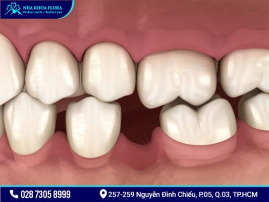 bệnh răng miệng - ảnh 6