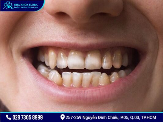 bệnh răng miệng - ảnh 7