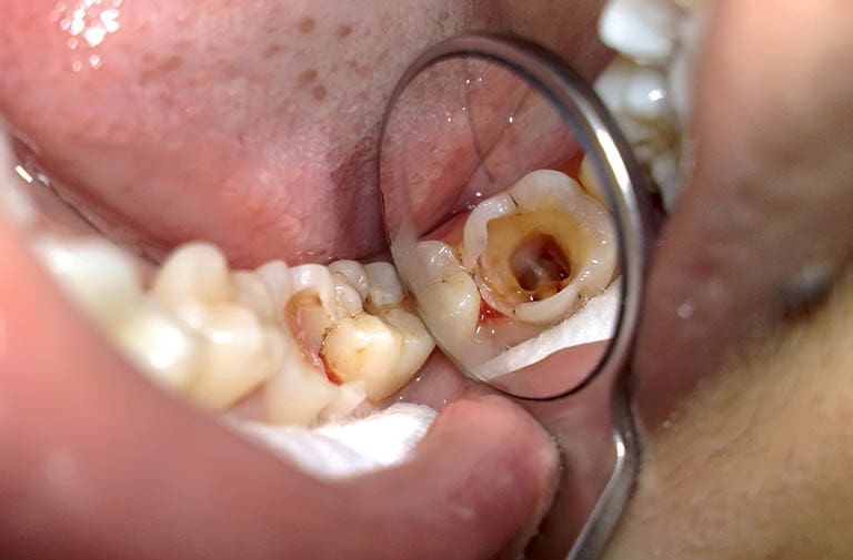 răng sâu lồi thịt