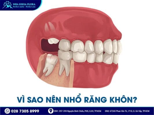 nhổ răng khôn có đau không - ảnh 1