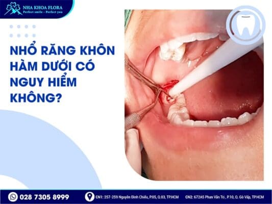 nhổ răng khôn hàm dưới - ảnh 1