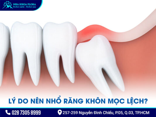 nhổ răng khôn mọc lệch - ảnh 1