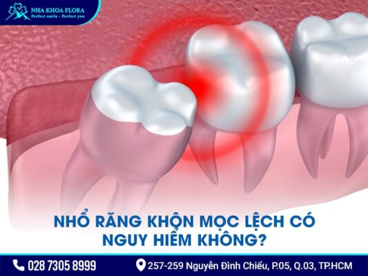 nhổ răng khôn mọc lệch - ảnh 2