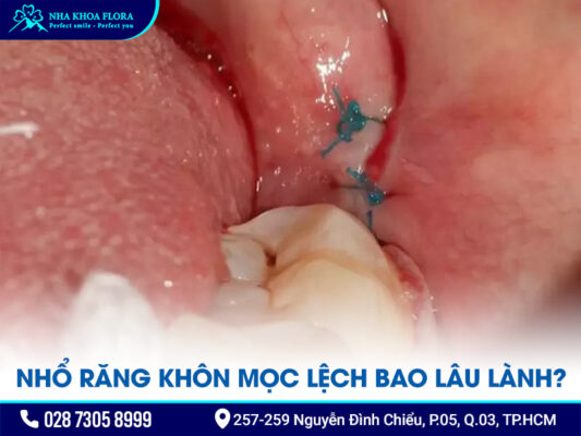 nhổ răng khôn mọc lệch - ảnh 3