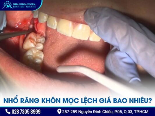 nhổ răng khôn mọc lệch - ảnh 4