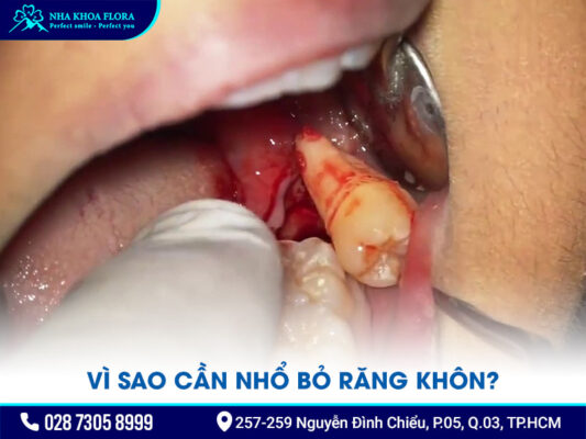 Phương pháp nhổ răng khôn không đau - ảnh 1