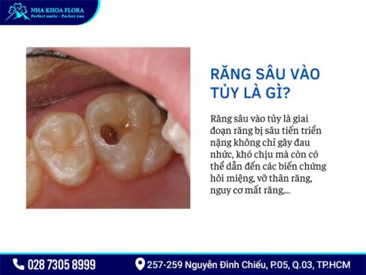 răng sâu vào tủy - ảnh 1 răng sâu vào tủy - ảnh 1