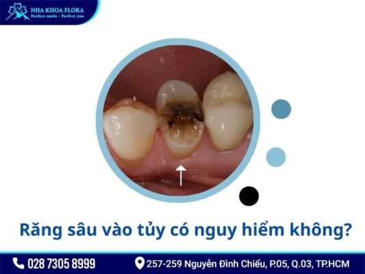 răng sâu vào tủy - ảnh 2 răng sâu vào tủy - ảnh 2