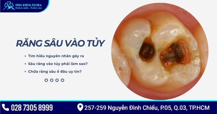 răng sâu vào tủy