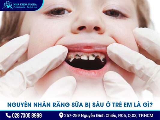 răng sữa bị sâu - ảnh 1