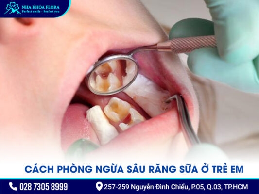 răng sữa bị sâu - ảnh 4