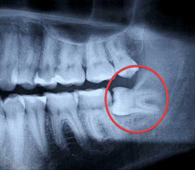 Sâu răng số 8 thi nên làm gì? Chữa trị hay Nhổ bỏ 3